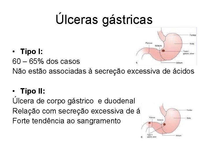 Úlceras gástricas • Tipo I: 60 – 65% dos casos Não estão associadas à