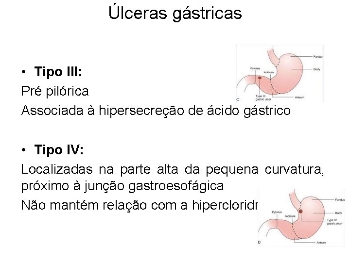 Úlceras gástricas • Tipo III: Pré pilórica Associada à hipersecreção de ácido gástrico •