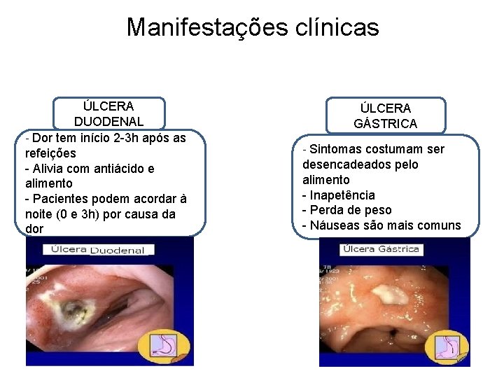 Manifestações clínicas ÚLCERA DUODENAL - Dor tem início 2 -3 h após as refeições