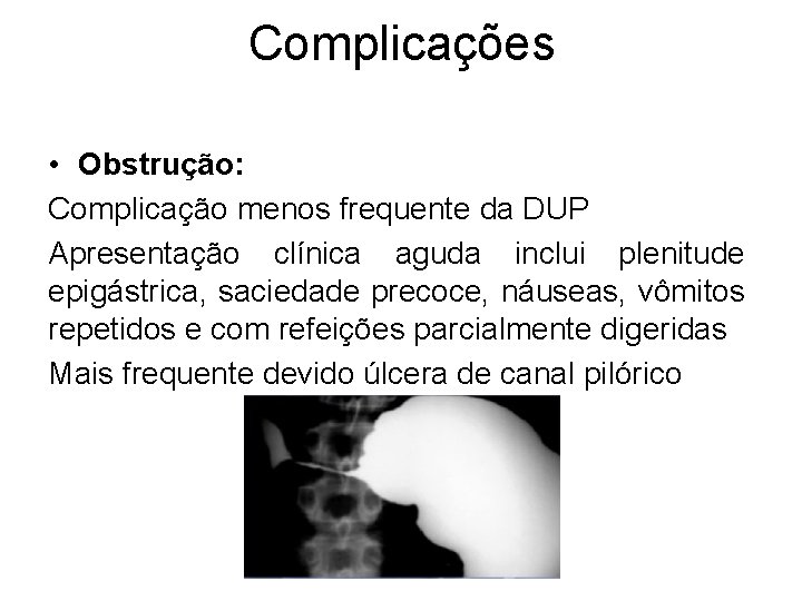 Complicações • Obstrução: Complicação menos frequente da DUP Apresentação clínica aguda inclui plenitude epigástrica,