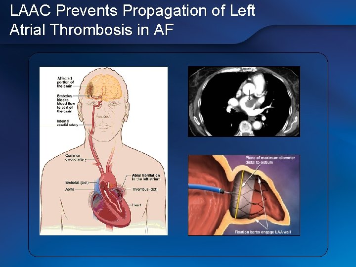 LAAC Prevents Propagation of Left Atrial Thrombosis in AF 