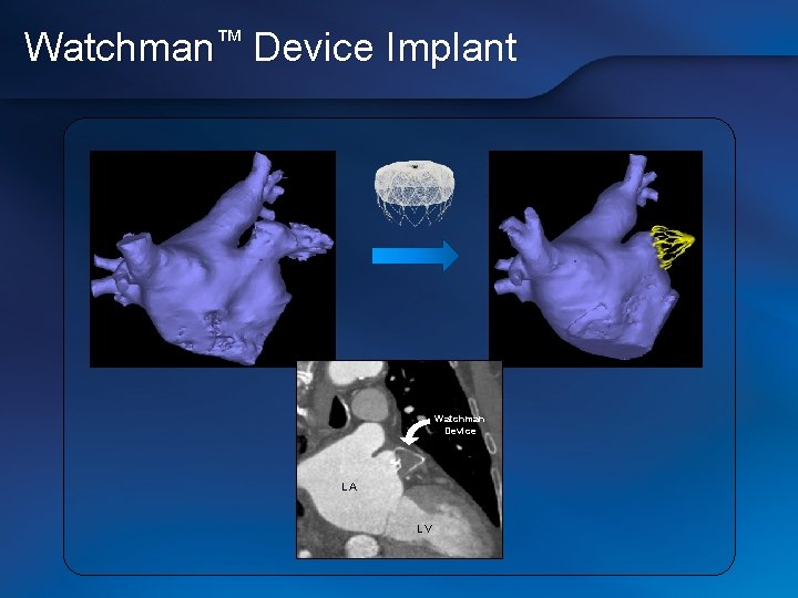 Watchman™ Device Implant Watchman Device LA LV 