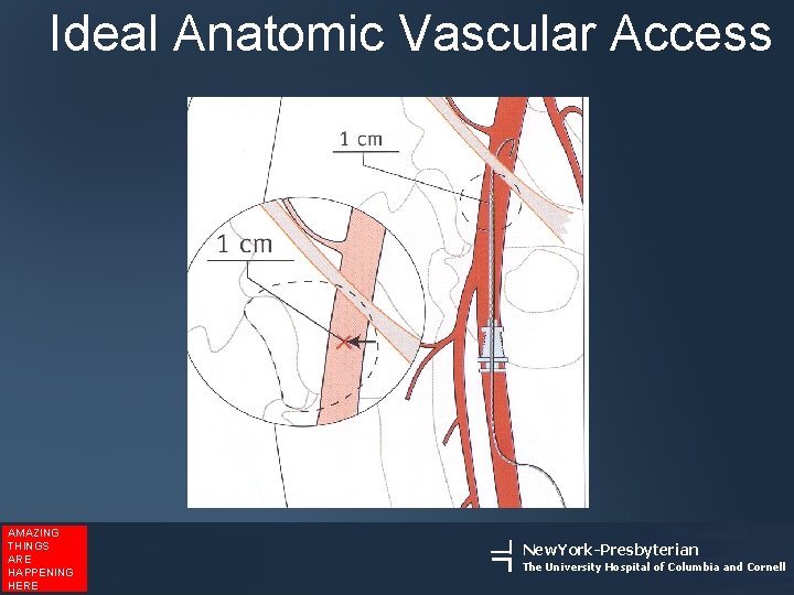 Ideal Anatomic Vascular Access AMAZING THINGS ARE HAPPENING HERE New. York-Presbyterian The University Hospital