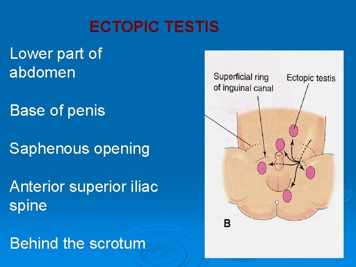 ECTOPIC TESTIS Lower part of abdomen Base of penis Saphenous opening Anterior superior iliac