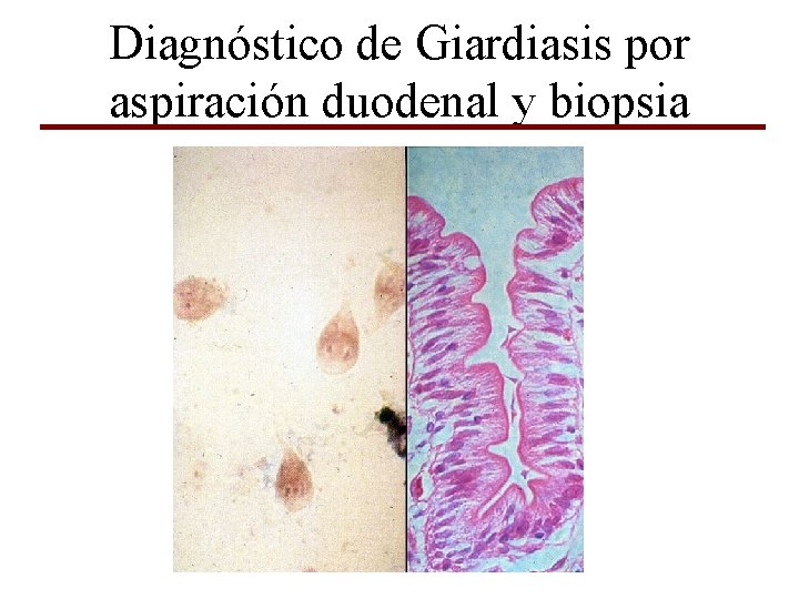 Diagnóstico de Giardiasis por aspiración duodenal y biopsia 