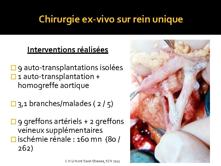 Chirurgie ex-vivo sur rein unique Interventions réalisées � 9 auto-transplantations isolées � 1 auto-transplantation