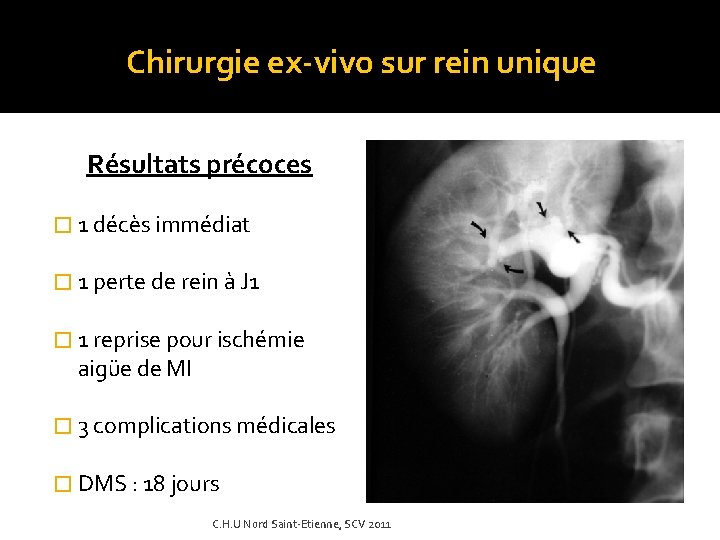 Chirurgie ex-vivo sur rein unique Résultats précoces � 1 décès immédiat � 1 perte