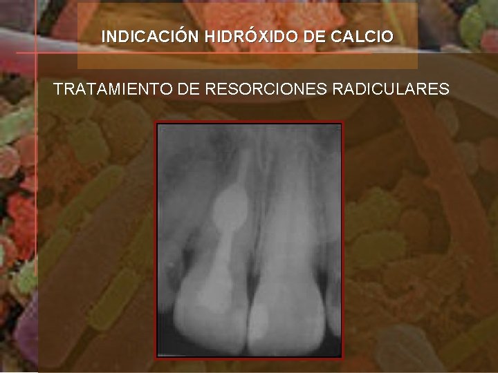 INDICACIÓN HIDRÓXIDO DE CALCIO TRATAMIENTO DE RESORCIONES RADICULARES 