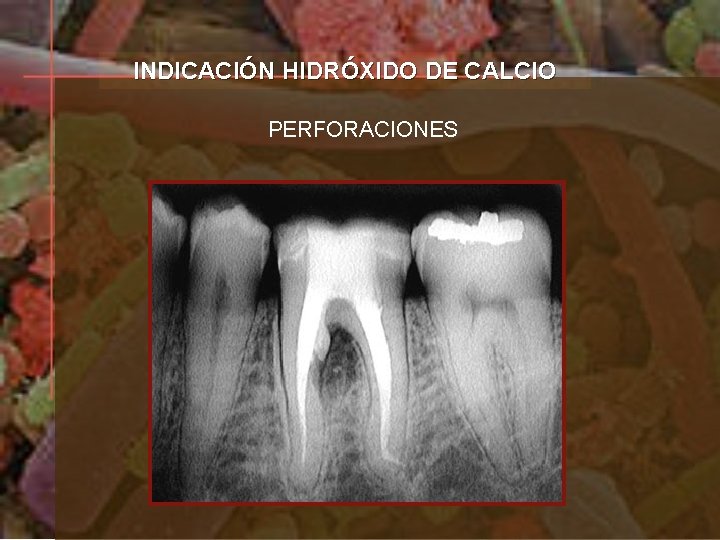 INDICACIÓN HIDRÓXIDO DE CALCIO PERFORACIONES 