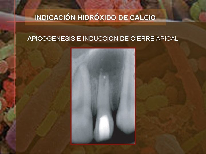 INDICACIÓN HIDRÓXIDO DE CALCIO APICOGÉNESIS E INDUCCIÓN DE CIERRE APICAL 