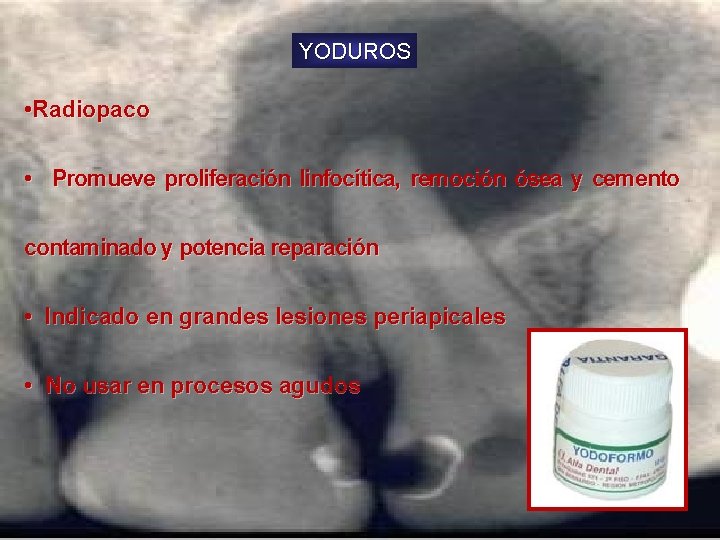 YODUROS • Radiopaco • Promueve proliferación linfocítica, remoción ósea y cemento contaminado y potencia