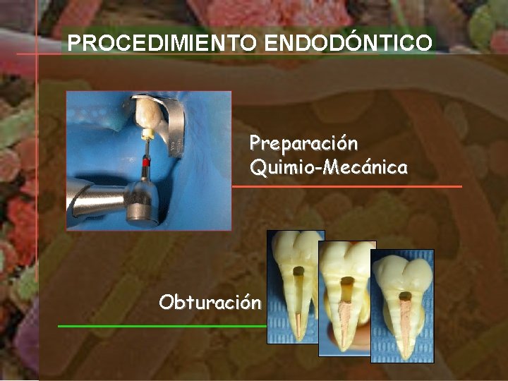 PROCEDIMIENTO ENDODÓNTICO Preparación Quimio-Mecánica Obturación 