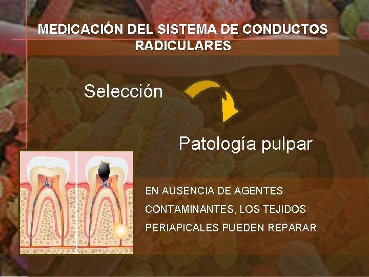MEDICACIÓN DEL SISTEMA DE CONDUCTOS RADICULARES Selección Patología pulpar EN AUSENCIA DE AGENTES CONTAMINANTES,