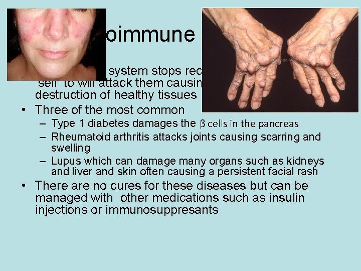 Autoimmune diseases • The immune system stops recognising some cells as ‘self’ to will