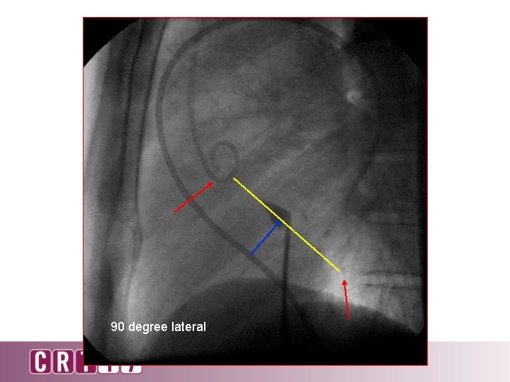 90 degree lateral 