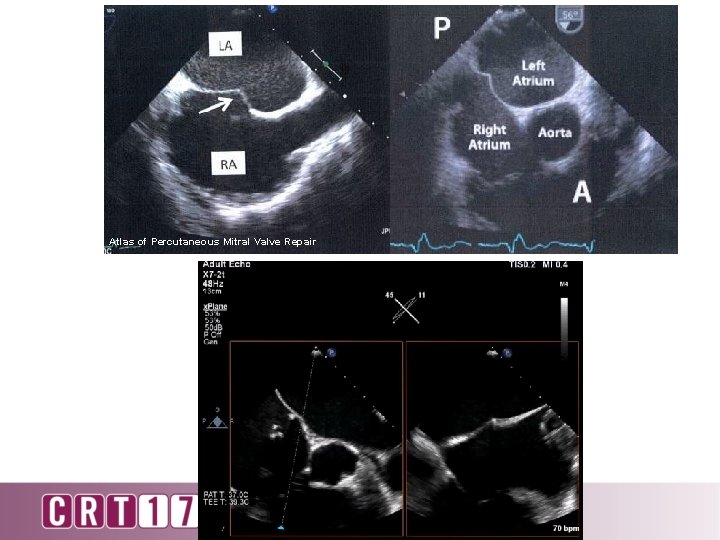 Atlas of Percutaneous Mitral Valve Repair 