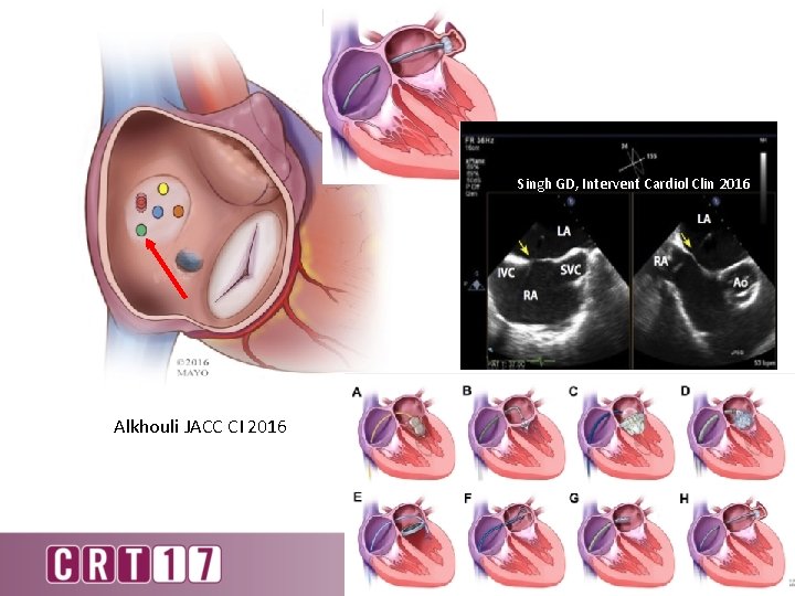 Singh GD, Intervent Cardiol Clin 2016 Alkhouli JACC CI 2016 