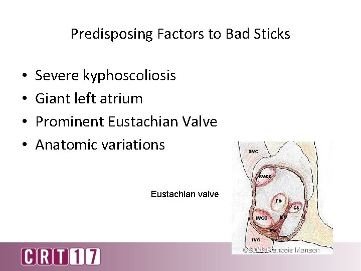 Predisposing Factors to Bad Sticks • • Severe kyphoscoliosis Giant left atrium Prominent Eustachian