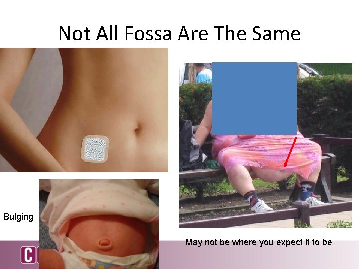 Not All Fossa Are The Same Bulging May not be where you expect it