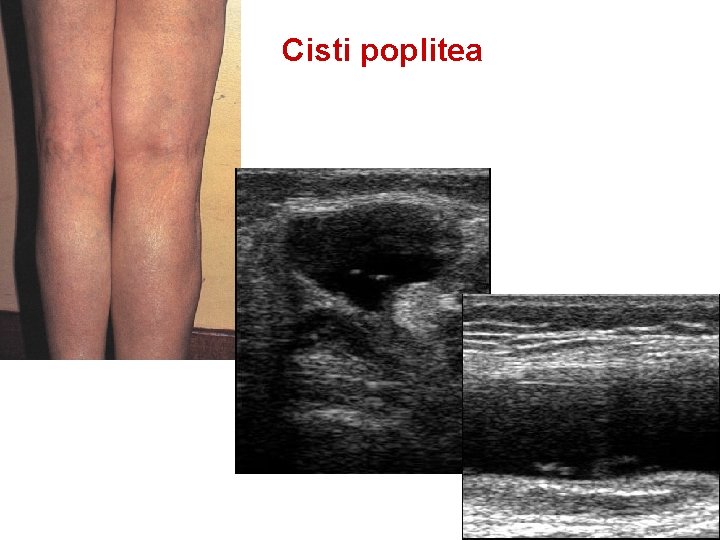 Cisti poplitea 