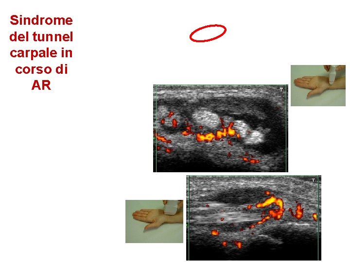Sindrome del tunnel carpale in corso di AR 