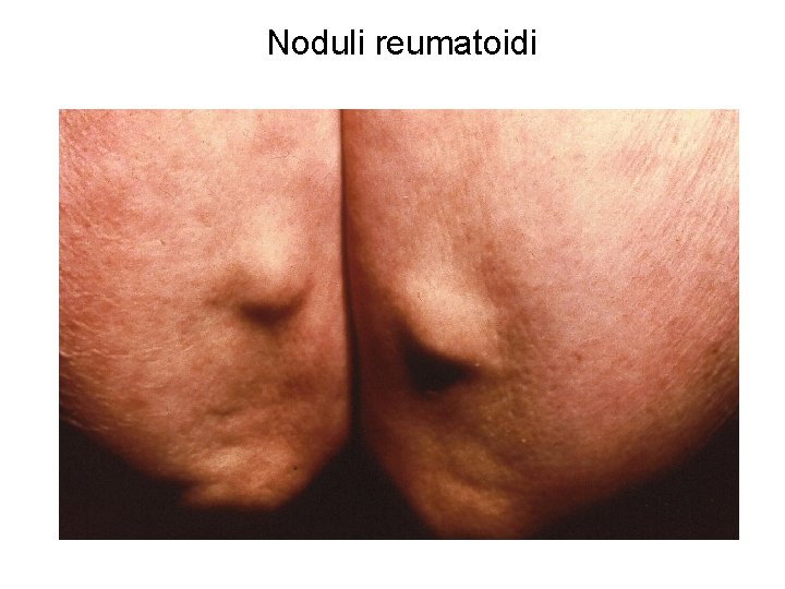 Noduli reumatoidi 