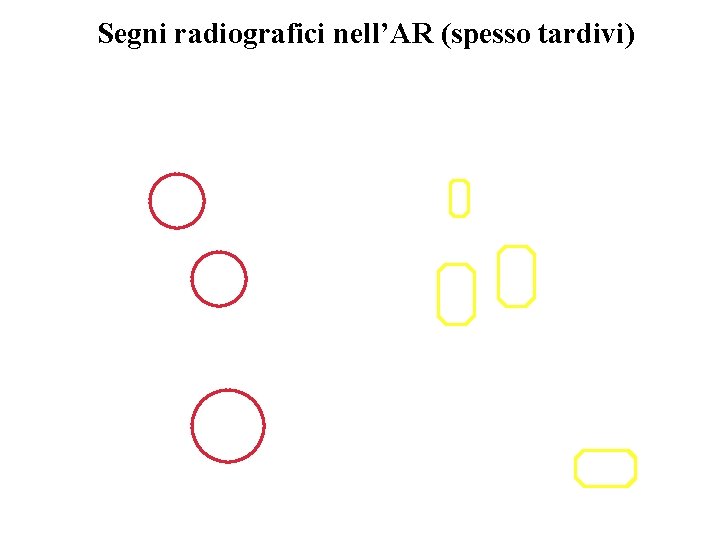 Segni radiografici nell’AR (spesso tardivi) 
