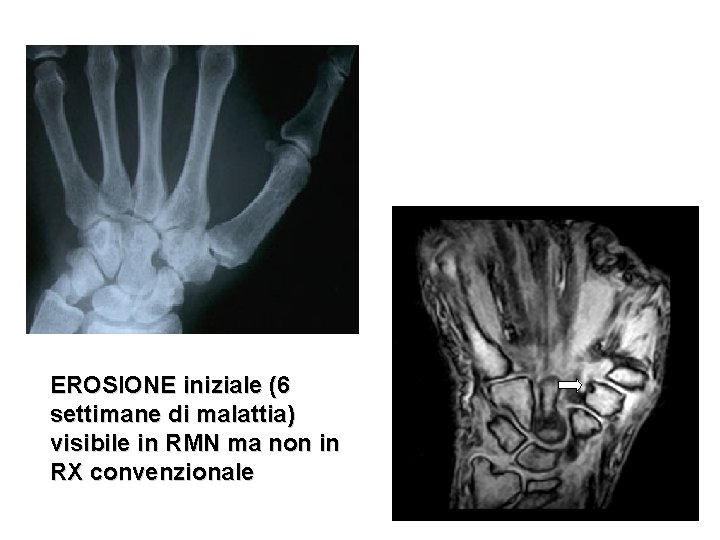 EROSIONE iniziale (6 settimane di malattia) visibile in RMN ma non in RX convenzionale