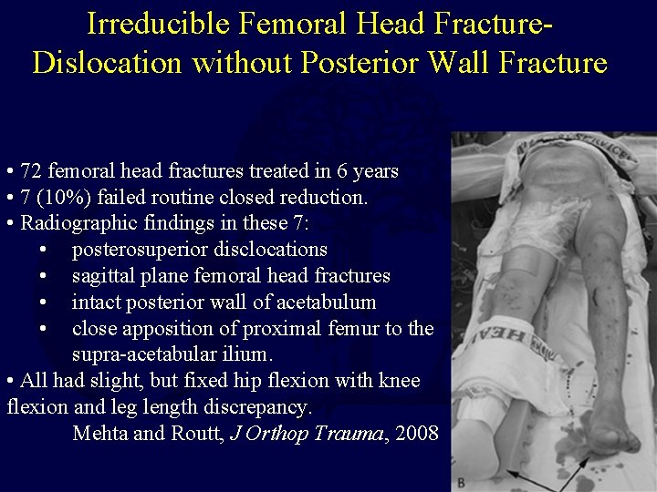 Irreducible Femoral Head Fracture. Dislocation without Posterior Wall Fracture • 72 femoral head fractures