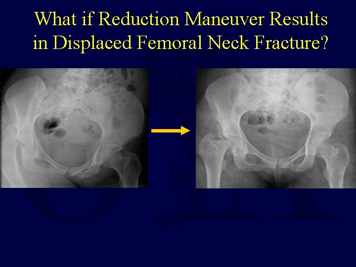 What if Reduction Maneuver Results in Displaced Femoral Neck Fracture? 