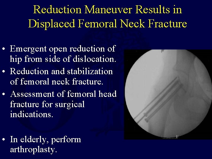 Reduction Maneuver Results in Displaced Femoral Neck Fracture • Emergent open reduction of hip