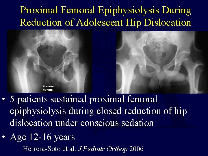Proximal Femoral Epiphysiolysis During Reduction of Adolescent Hip Dislocation • 5 patients sustained proximal