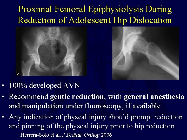 Proximal Femoral Epiphysiolysis During Reduction of Adolescent Hip Dislocation • 100% developed AVN •