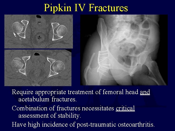 Pipkin IV Fractures Require appropriate treatment of femoral head and acetabulum fractures. Combination of