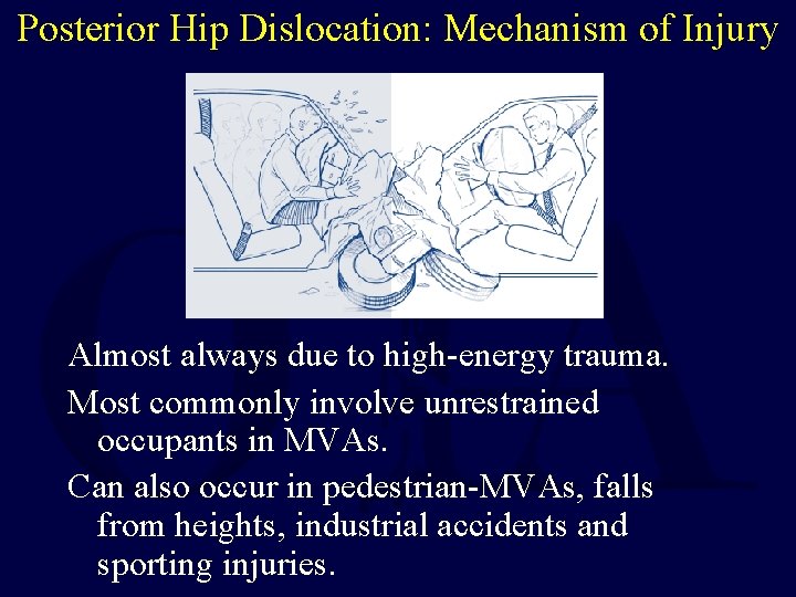 Posterior Hip Dislocation: Mechanism of Injury Almost always due to high-energy trauma. Most commonly