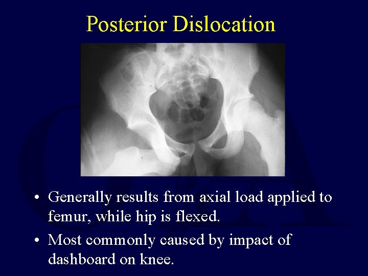 Posterior Dislocation • Generally results from axial load applied to femur, while hip is