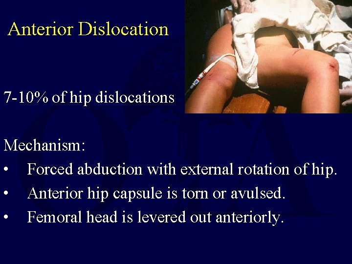Anterior Dislocation 7 -10% of hip dislocations Mechanism: • Forced abduction with external rotation