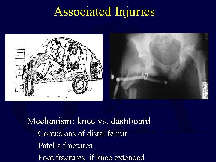 Associated Injuries Mechanism: knee vs. dashboard Contusions of distal femur Patella fractures Foot fractures,