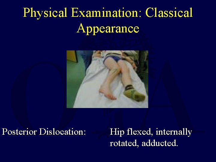 Physical Examination: Classical Appearance Posterior Dislocation: Hip flexed, internally rotated, adducted. 