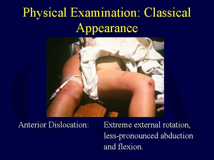 Physical Examination: Classical Appearance Anterior Dislocation: Extreme external rotation, less-pronounced abduction and flexion. 