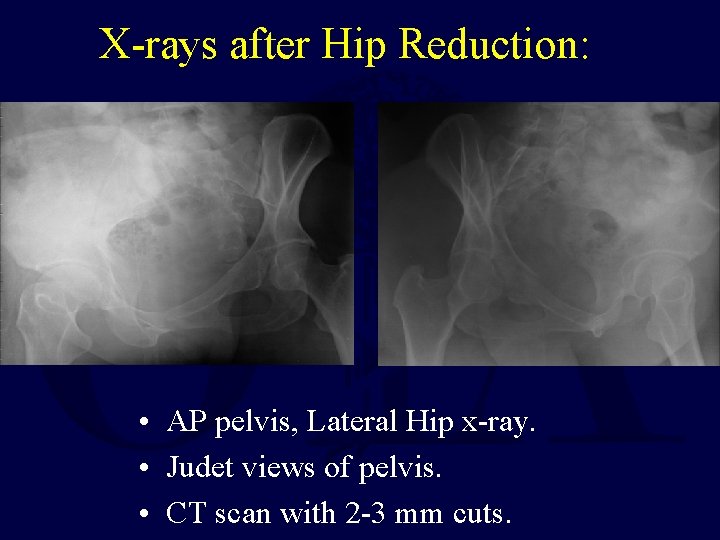 X-rays after Hip Reduction: • AP pelvis, Lateral Hip x-ray. • Judet views of