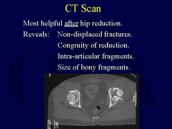 CT Scan Most helpful after hip reduction. Reveals: Non-displaced fractures. Congruity of reduction. Intra-articular