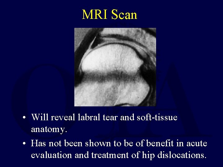 MRI Scan • Will reveal labral tear and soft-tissue anatomy. • Has not been