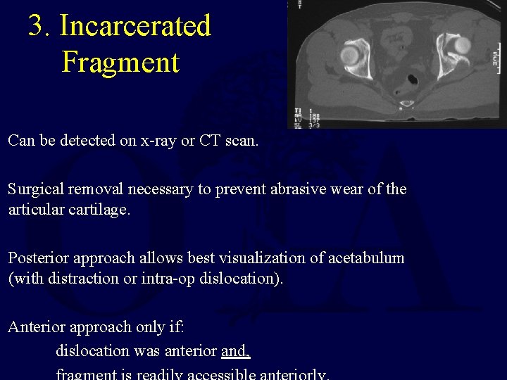 3. Incarcerated Fragment Can be detected on x-ray or CT scan. Surgical removal necessary