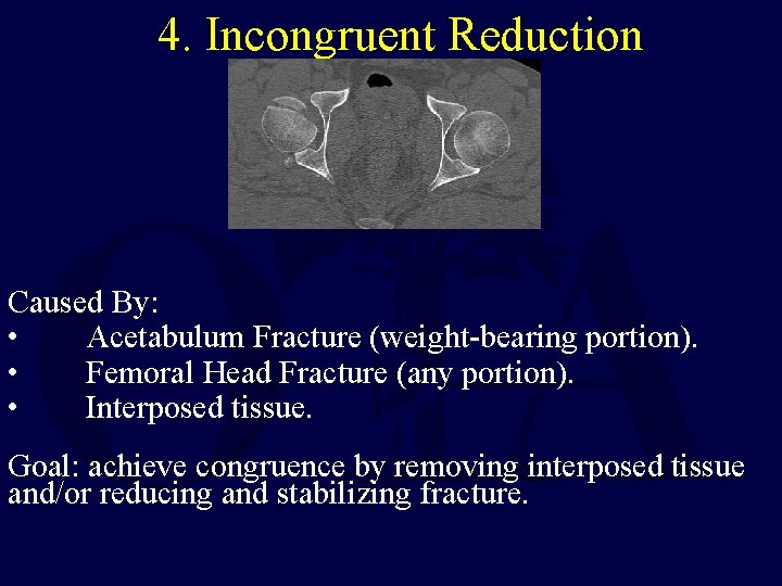4. Incongruent Reduction Caused By: • Acetabulum Fracture (weight-bearing portion). • Femoral Head Fracture