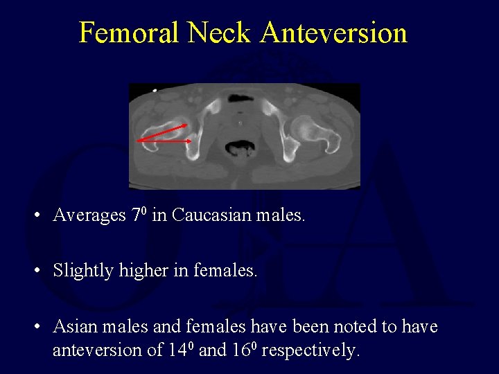 Femoral Neck Anteversion • Averages 70 in Caucasian males. • Slightly higher in females.