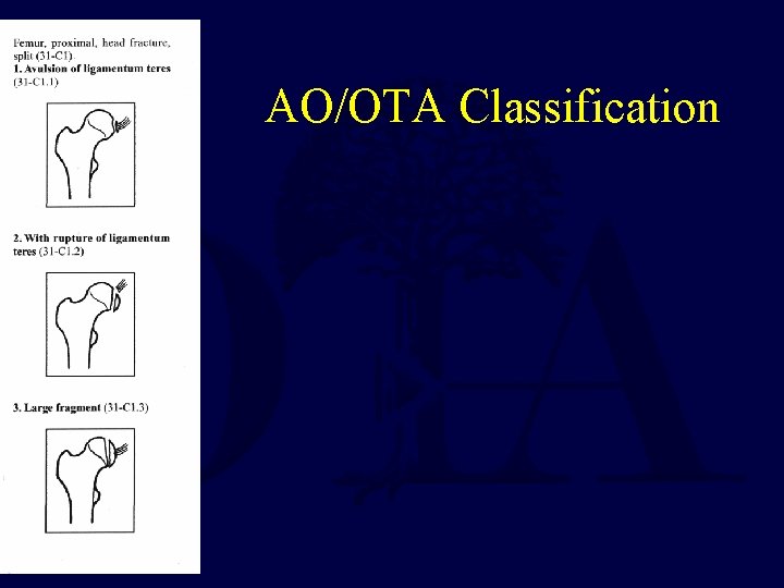 AO/OTA Classification 