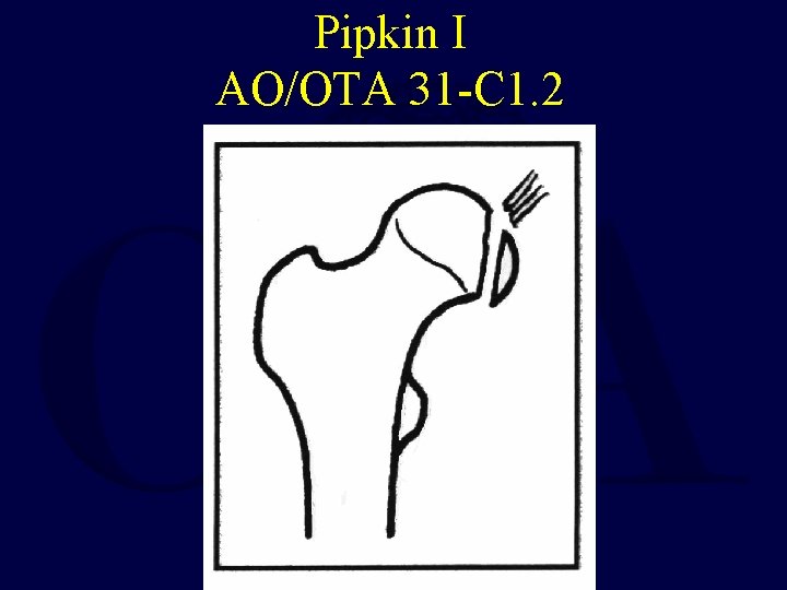 Pipkin I AO/OTA 31 -C 1. 2 