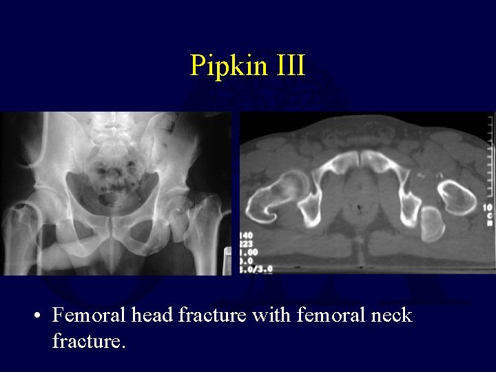 Pipkin III • Femoral head fracture with femoral neck fracture. 