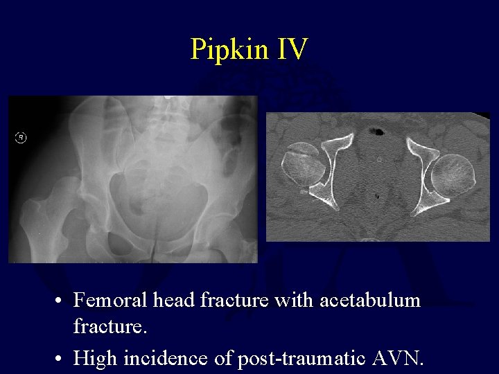 Pipkin IV • Femoral head fracture with acetabulum fracture. • High incidence of post-traumatic